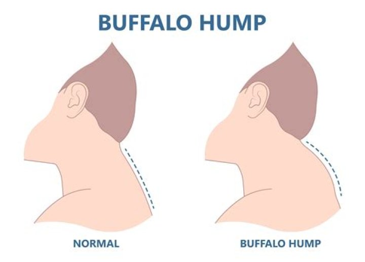 What causes a fat neck?