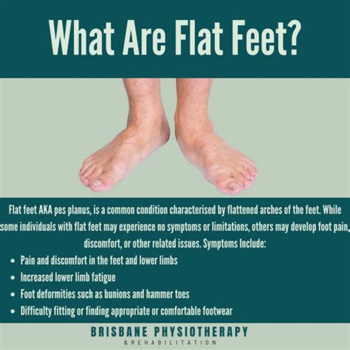 What causes flat feet?