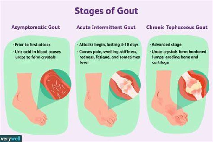 What causes gout in your foot?