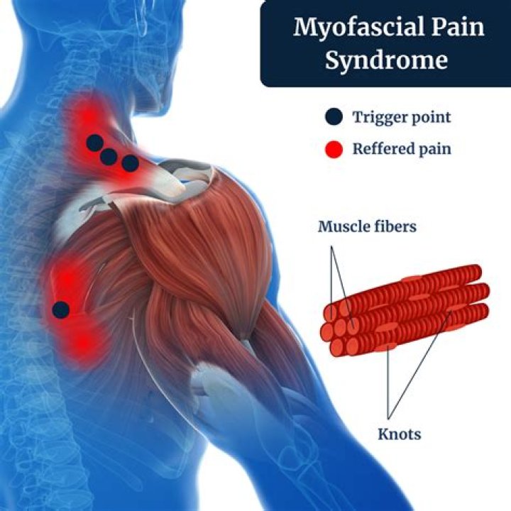 What causes myofascial knots?
