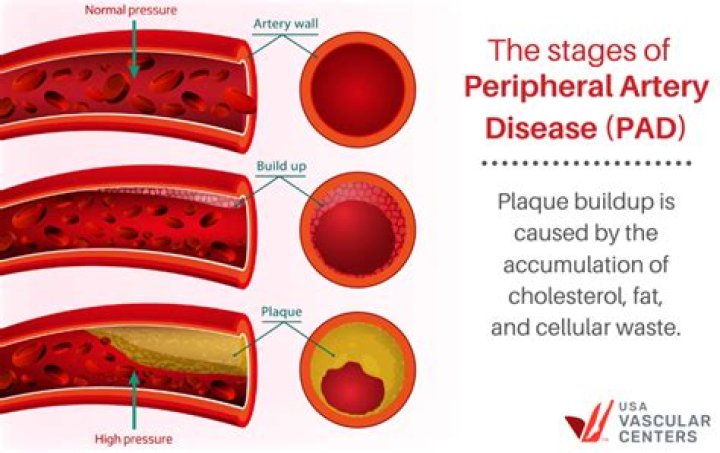 What causes plaque buildup in the brain?
