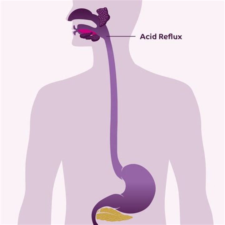 What does acid reflux do to throat?