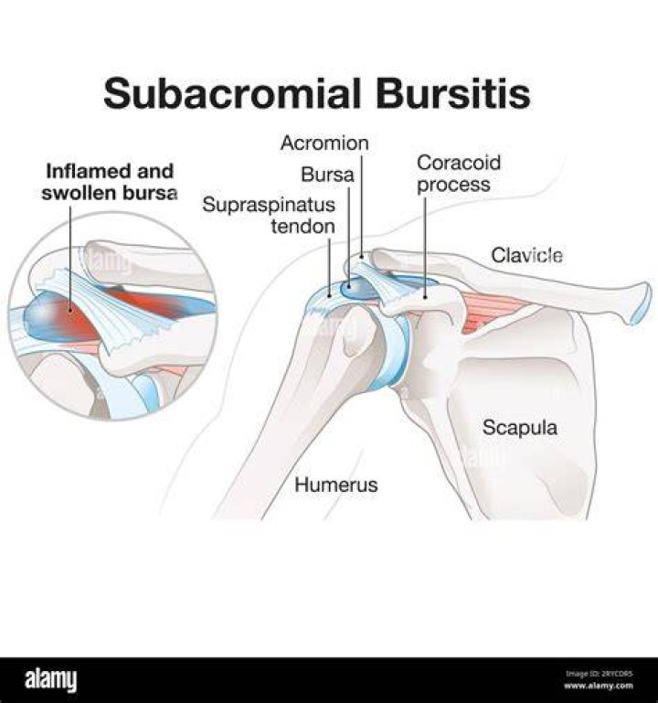 What does bursitis in the shoulder feel like?