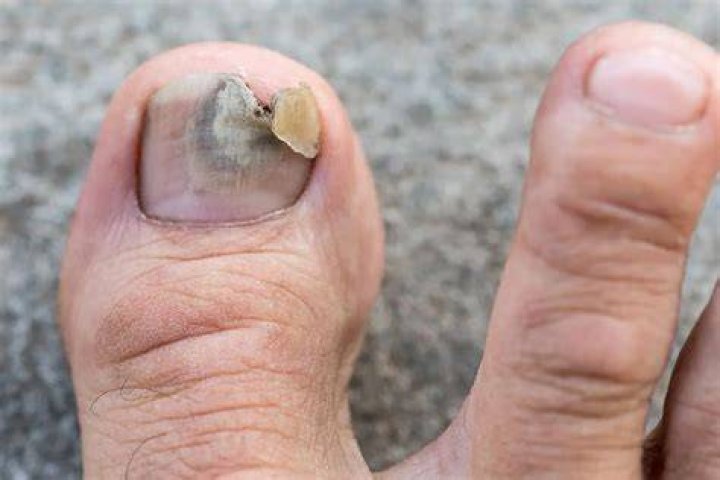 What does it mean when your toenail is throbbing?