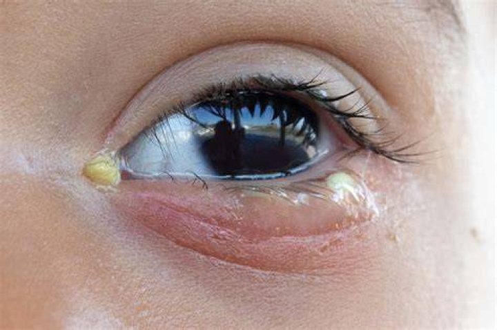 What does oozing pus look like?
