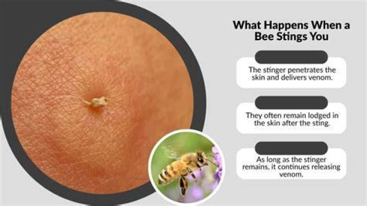 What happens if a bee stinger is not removed?