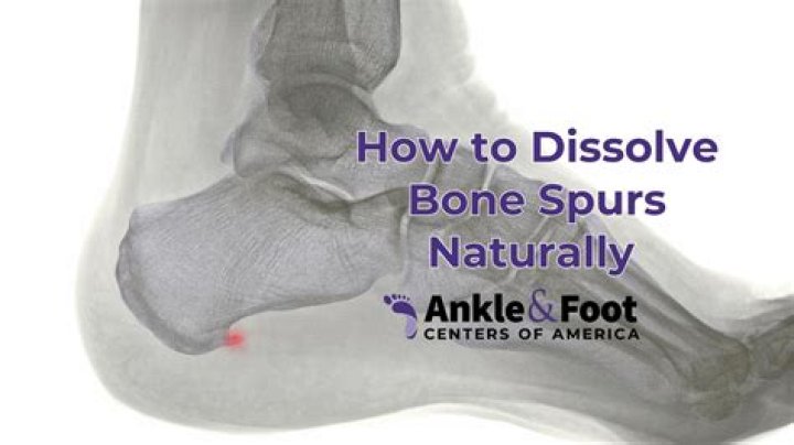 What happens if a bone spur breaks off?