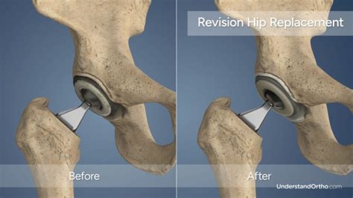 What happens if you bend over after hip replacement?
