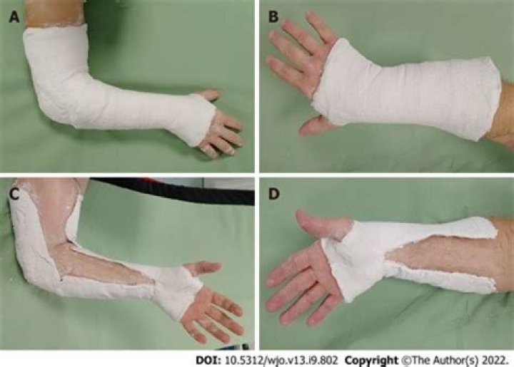 What happens if you don't cast a fracture?