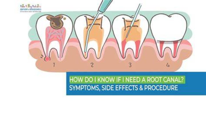 What happens if you don't get a root canal when needed?