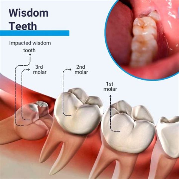 What happens if you don't remove your wisdom teeth?