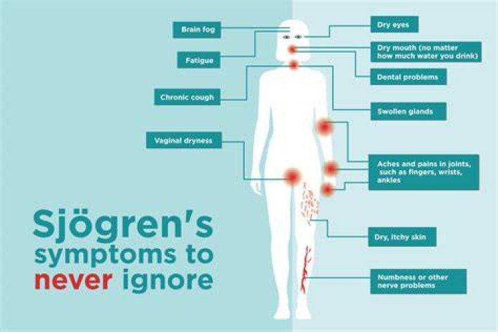 What helps Sjogren's flare up?