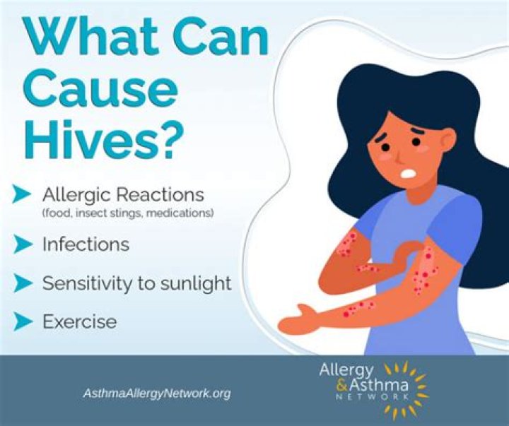 What illness can cause hives?