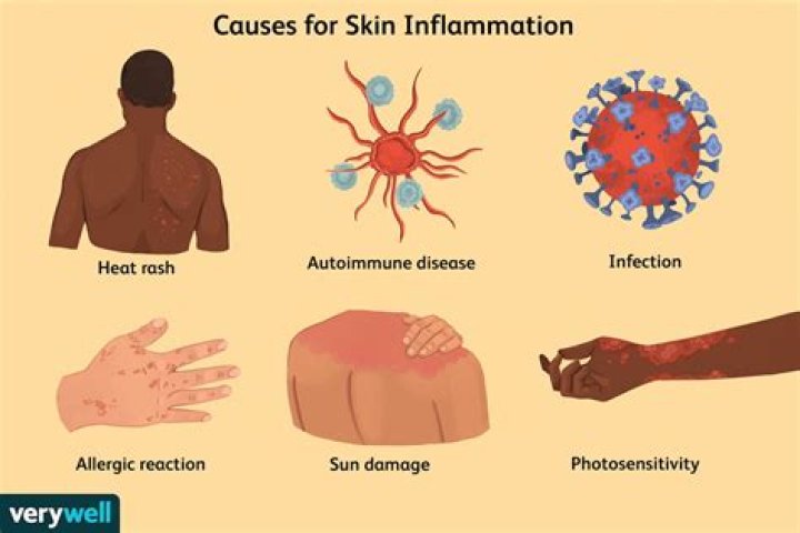 What infections cause inflammation?