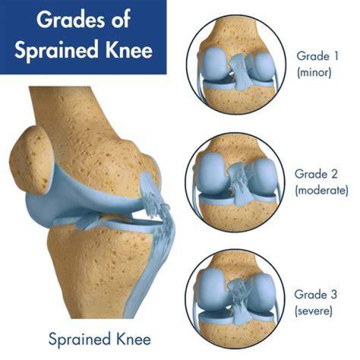 What is a Grade 3 knee sprain?