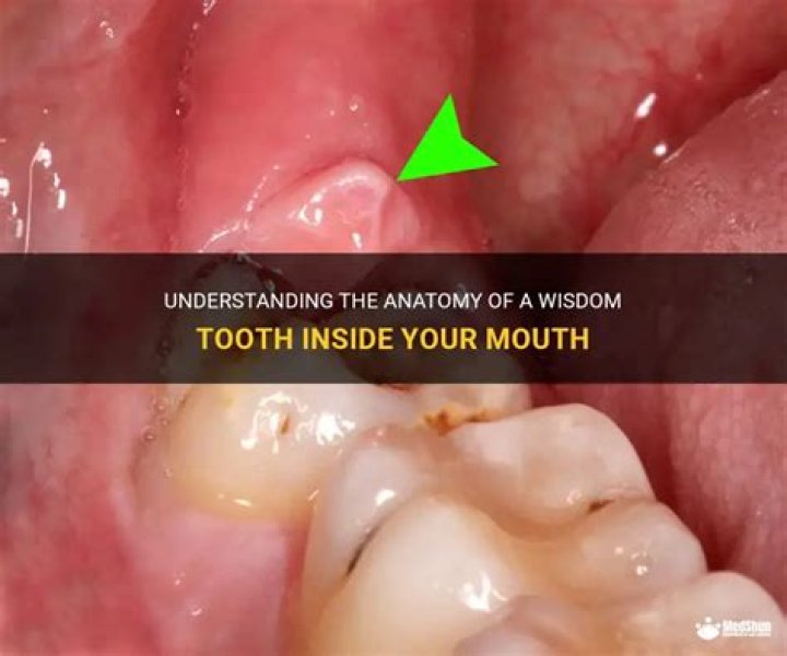What is a wisdom teeth?