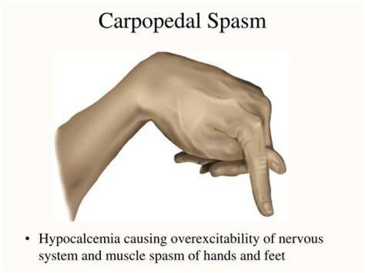 What is Carpopedal spasm?