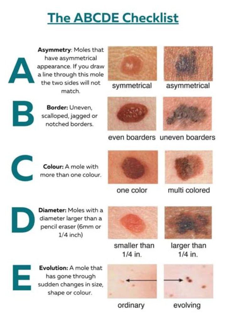 What is considered early detection for melanoma?
