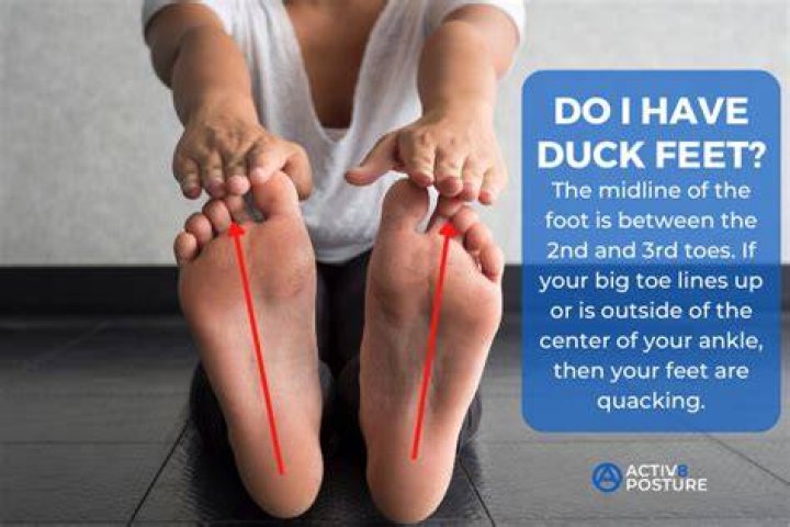 What is duck footed?