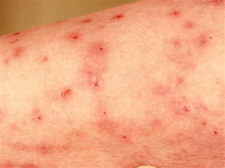 What is lymphoma itch like?