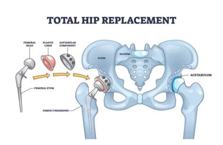 What is the best age for a hip replacement?