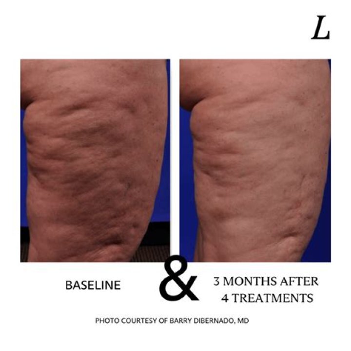 What is the best procedure to get rid of cellulite?
