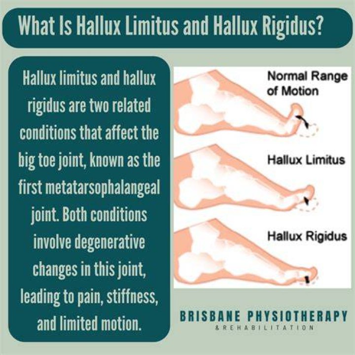 What is the best surgery for hallux rigidus?
