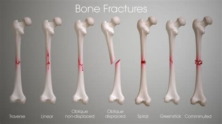 What is the hardest bone to break?