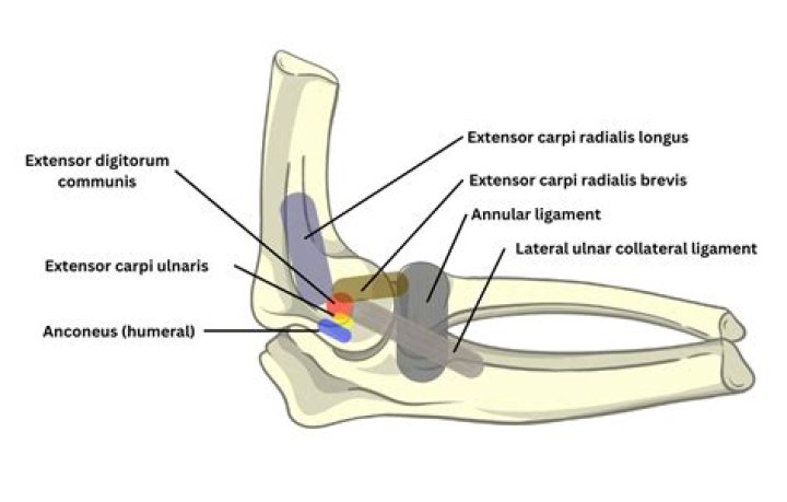 What is the most common cause of tennis elbow?