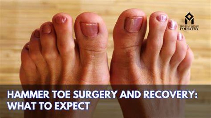What kind of doctor fixes hammer toe?