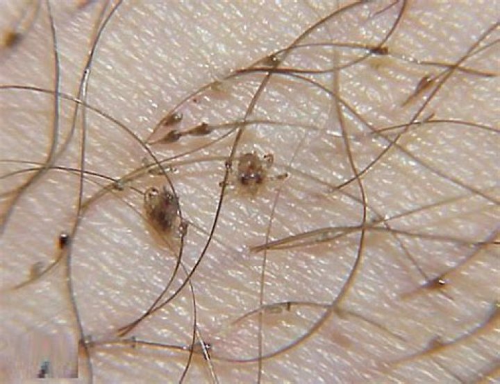 What percentage of people have pubic lice?