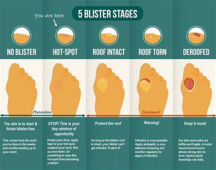 What to put on blisters on feet?