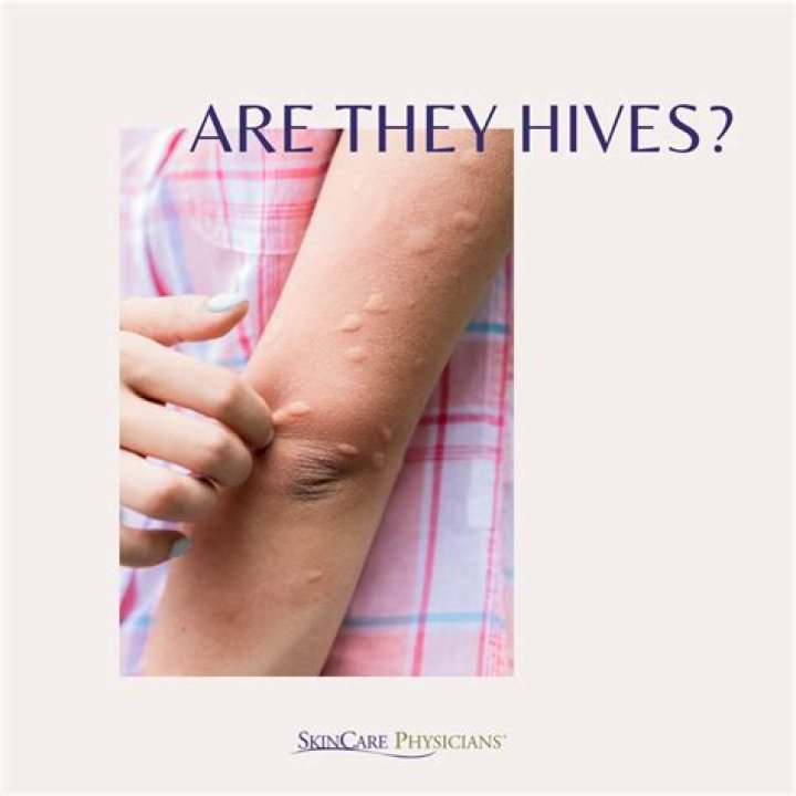 When should you see a doctor for hives?