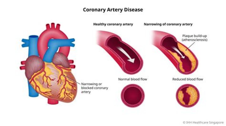 Which artery is the most common to have blockage?
