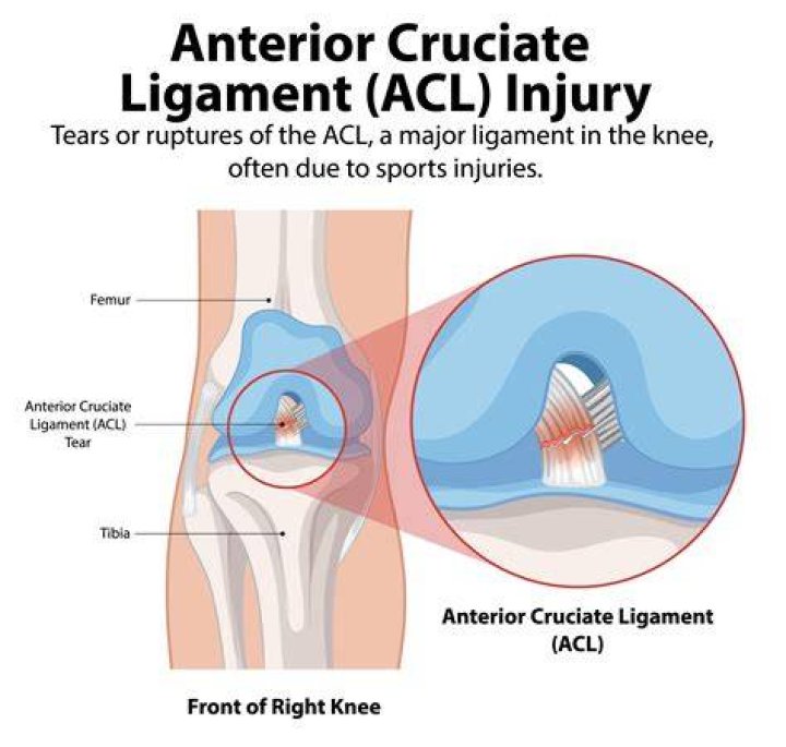Which band of the UCL is most commonly torn?