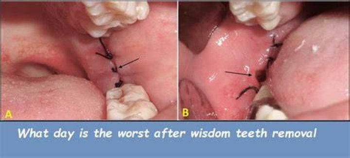 Which day is worse after wisdom teeth removal?
