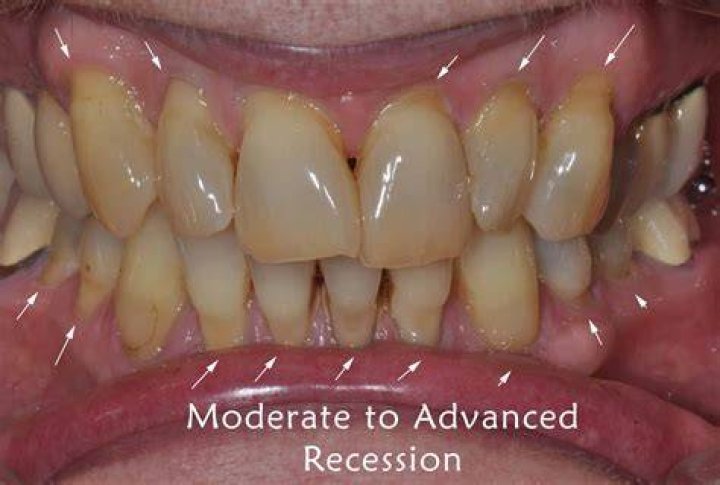 Which Sensodyne is best for gum recession?
