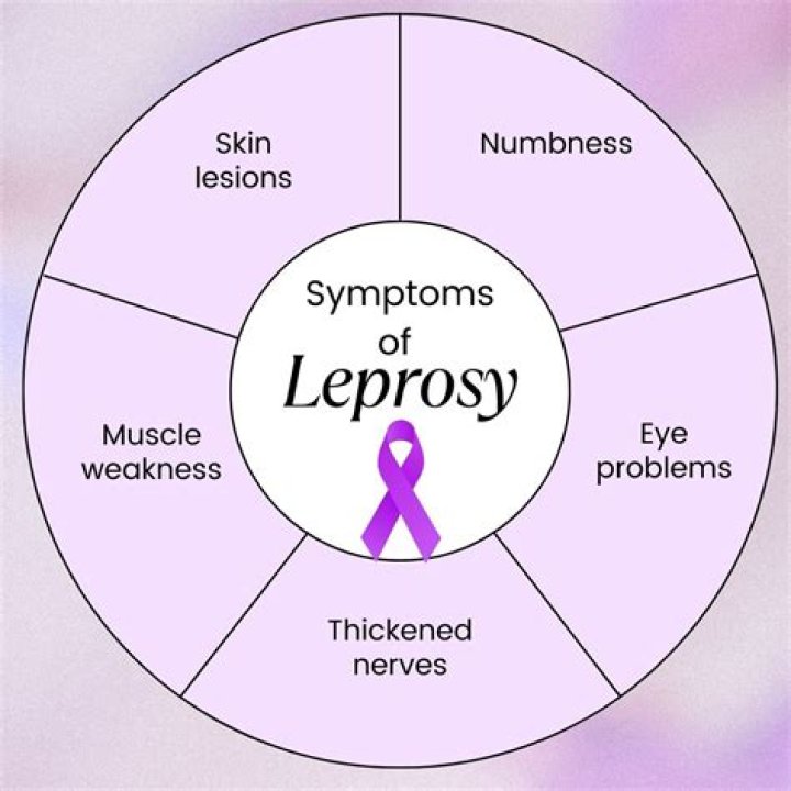 Who is at risk for leprosy?