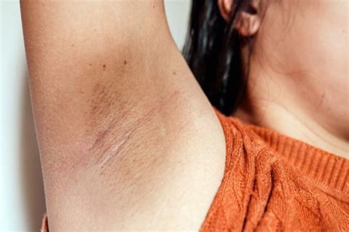 Why are my armpits so dark and itchy?