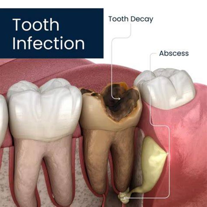 Why can't you pull a tooth with an abscess?