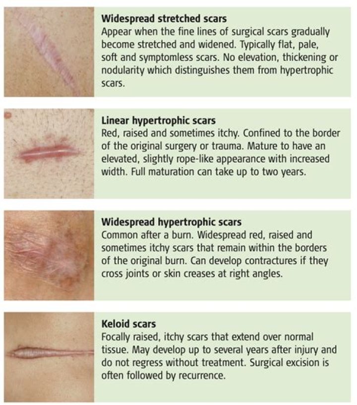 Why do healed scars itch?