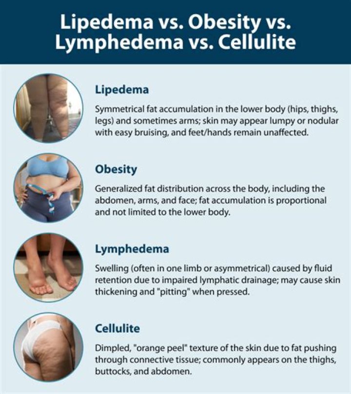Why do I have cellulite but I'm skinny?
