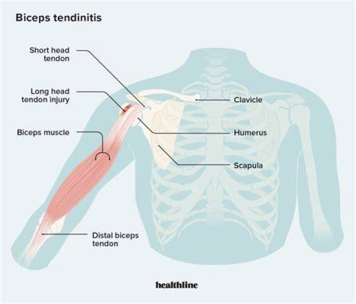 Why do I keep having tendon issues?