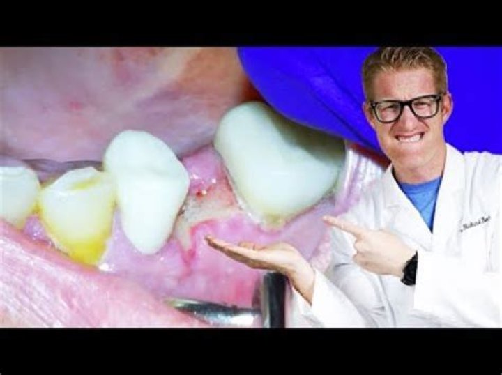 Why is there white stuff in my tooth extraction site?