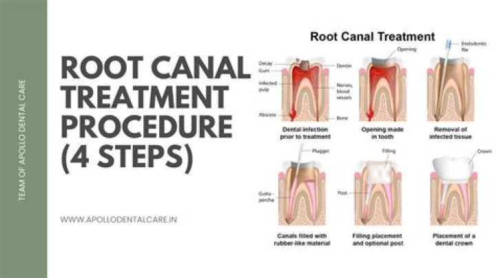 Will a dentist do a root canal if there is an infection?