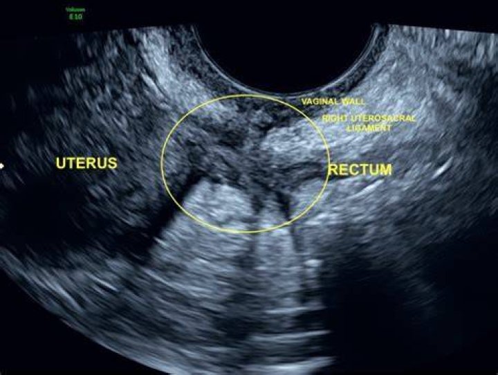 Would a tumor show up on ultrasound?